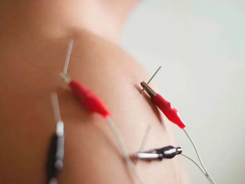 punción seca y electropunción